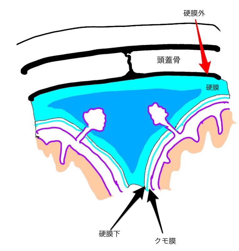 頭部ctで遭遇する謎の呪文 エピドラ サブドラって何 その覚え方 放射線技師一年目の教科書